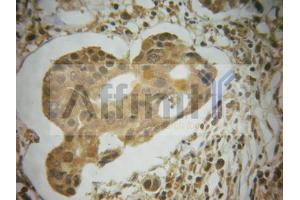 ABIN6267585 at 1/100 staining human breast carcinoma tissues sections by IHC-P. (MDM2 Antikörper  (pSer166))