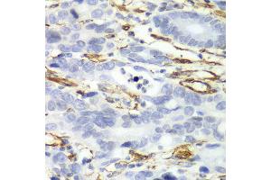 Immunohistochemistry of paraffin-embedded human gastric cancer using CALD1 antibody at dilution of 1:100 (x40 lens). (Caldesmon Antikörper)