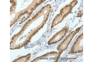 Immunohistochemistry of Human liver cancer using ASH2L Polyclonal Antibody at dilution of 1:50 (ASH2L Antikörper)