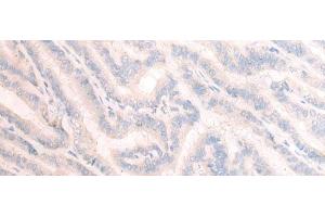 Immunohistochemistry of paraffin-embedded Human thyroid cancer tissue using TBC1D2 Polyclonal Antibody at dilution of 1:25(x200) (TBC1D2 Antikörper)