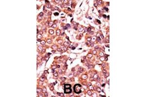 Formalin-fixed and paraffin-embedded human cancer tissue reacted with the primary antibody, which was peroxidase-conjugated to the secondary antibody, followed by AEC staining. (CDC25A Antikörper  (pSer278))