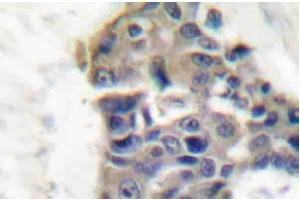 Immunohistochemistry Analysis: AP20200PU-N Synaptotagmin antibody staining of Paraffin-Embedded Human breast carcinoma tissue. (SYT1 Antikörper)