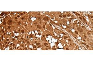 Immunohistochemistry of paraffin-embedded Human esophagus cancer tissue using LAMTOR5 Polyclonal Antibody at dilution of 1:35(x200) (HBXIP Antikörper)