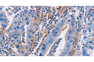 Immunohistochemistry of paraffin-embedded Human gastric cancer using CD54 Polyclonal Antibody at dilution of 1:30 (ICAM1 Antikörper)