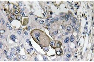 Immunohistochemistry analysis of AQP5 Antibody in paraffin-embedded human lung carcinoma tissue. (Aquaporin 5 Antikörper)