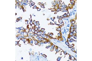 Immunohistochemistry of paraffin-embedded human lung cancer using Cytokeratin 7 (Cytokeratin 7 (KRT7)) antibody (ABIN6129292, ABIN6143037, ABIN6143039 and ABIN6215559) at dilution of 1:200 (40x lens). (Cytokeratin 7 Antikörper  (AA 1-94))