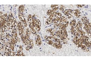 Human parathyroid adenoma: immunohistochemical staining for Parathyroid Hormone. (PTH Antikörper)