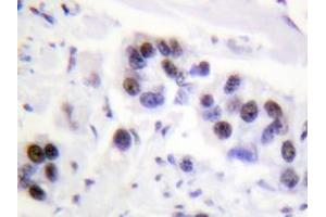 Immunohistochemistry analyzes of Histone H4 antibody in paraffin-embedded human breast carcinoma tissue. (Histone H4 Antikörper)