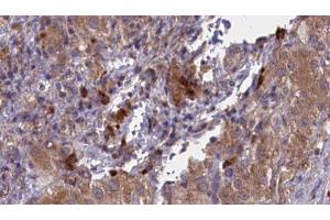 ABIN6277051 at 1/100 staining Human liver cancer tissue by IHC-P. (CD33 Antikörper  (C-Term))