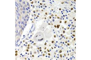 Immunohistochemistry of paraffin-embedded human lung cancer using GEMIN2 Antibody. (SIP1 Antikörper)