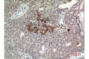 Immunohistochemical analysis of paraffin-embedded human-Breast-cancer, antibody was diluted at 1:100. (STING/TMEM173 Antikörper  (C-Term))