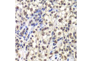 Immunohistochemistry of paraffin-embedded human kidney cancer using CENPC antibody (ABIN5973936) at dilution of 1/200 (40x lens). (Centromere Protein C Pseudogene 1 (CENPCP1) Antikörper)