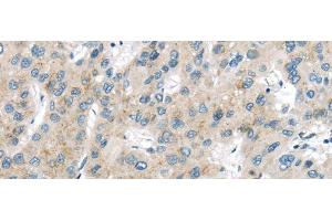 Immunohistochemistry of paraffin-embedded Human liver cancer using VPS26A Polyclonal Antibody at dilution of 1/40 (VPS26A Antikörper)