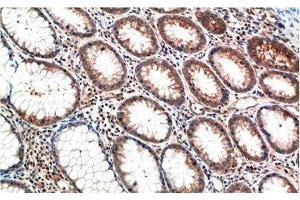 Immunohistochemistry of paraffin-embedded Human colon carcinoma tissue using ATM Monoclonal Antibody at dilution of 1:200. (ATM Antikörper)