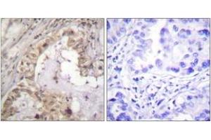 Immunohistochemistry analysis of paraffin-embedded human lung carcinoma tissue, using BCL-XL (Ab-47) Antibody. (BCL2L1 Antikörper  (AA 13-62))