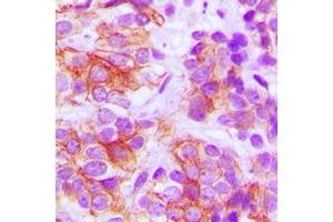 Immunohistochemical analysis of Frizzled 5 staining in human breast cancer formalin fixed paraffin embedded tissue section. (FZD5 Antikörper  (C-Term))