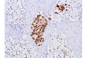 Immunohistochemistry of Human Prostate Adenocarcinoma stained with anti-Androgen Receptor (AR) antibody (Androgen Receptor Antikörper  (N-Term))