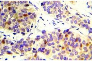 Immunohistochemistry (IHC) analyzes of CHK2 pAb in paraffin-embedded human lung adenocarcinoma tissue. (CHEK2 Antikörper)