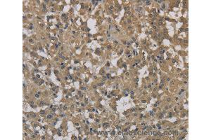 Immunohistochemistry of Human cervical cancer using DCTN3 Polyclonal Antibody at dilution of 1:70 (DCTN3 Antikörper)