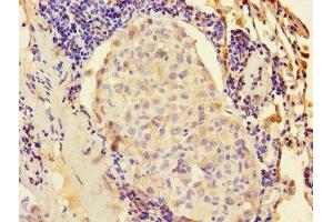 Immunohistochemistry of paraffin-embedded human lung cancer using ABIN7157432 at dilution of 1:100 (KRT6A Antikörper  (AA 2-564))