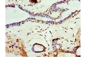 Immunohistochemistry of paraffin-embedded human breast cancer using ABIN7160457 at dilution of 1:100 (MOG Antikörper  (AA 30-154))