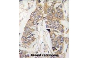 Formalin-fixed and paraffin-embedded human breast carcinoma tissue reacted with CASC3 Antibody (C-term) (ABIN391401 and ABIN2841404) , which was peroxidase-conjugated to the secondary antibody, followed by DAB staining. (CASC3 Antikörper  (AA 206-236))