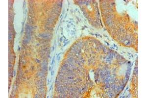 Immunohistochemical of paraffin-embedded Human Colon cancer tissue using ABIN7156047 at dilution of 1:200. (IL1A Antikörper)