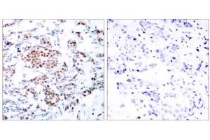 Immunohistochemical analysis of paraffin-embedded human breast carcinoma tissue using STAT5A (Ab-694) antibody (E021048). (STAT5A Antikörper)