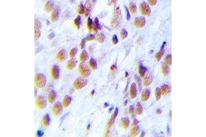 Immunohistochemical analysis of LSm4 staining in human breast cancer formalin fixed paraffin embedded tissue section. (LSM4 Antikörper)