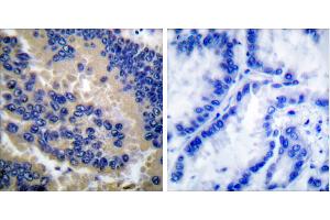 Cl-peptide - +Immunohistochemical analysis of paraffin-embedded human lung carcinoma tissue using Caspase 3 (cleaved-Asp175) antibody. (Caspase 3 Antikörper  (Cleaved-Asp175))