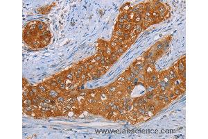 Immunohistochemistry of Human cervical cancer using MMP1 Polyclonal Antibody at dilution of 1:55 (MMP1 Antikörper)