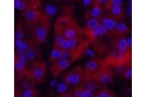 Immunofluorescence analysis of Human stomach cancer tissue using Ubiquitin Monoclonal Antibody at dilution of 1:200. (Ubiquitin Antikörper)