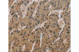 Immunohistochemistry of Human liver cancer using CORO1C Polyclonal Antibody at dilution of 1:50 (CORO1C Antikörper)