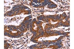 The image on the left is immunohistochemistry of paraffin-embedded Human colon cancer tissue using ABIN7129993(KIR2DL3/KIR2DL1/KIR2DL4/KIR2DS4 Antibody) at dilution 1/30, on the right is treated with fusion protein. (KIR2DL3/KIR2DL1/KIR2DL4/KIR2DS4 Antikörper)