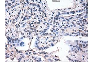 Immunohistochemical staining of paraffin-embedded Carcinoma of lung using anti-AKT3 (ABIN2452682) mouse monoclonal antibody. (AKT3 Antikörper  (AA 2-479))