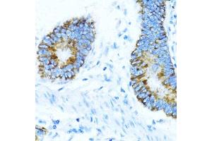 Immunohistochemistry of paraffin-embedded human colon carcinoma using NOX1 antibody (ABIN7268824) at dilution of 1:100 (40x lens). (NOX1 Antikörper  (AA 200-300))