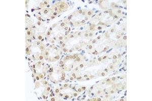 Immunohistochemistry of paraffin-embedded human gastric cancer using SNAI1 antibody (ABIN5975364) at dilution of 1/100 (40x lens). (SNAIL Antikörper)