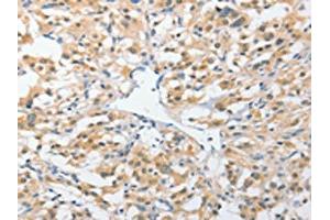 The image on the left is immunohistochemistry of paraffin-embedded Human thyroid cancer tissue using ABIN7131538(UCHL5 Antibody) at dilution 1/25, on the right is treated with fusion protein. (UCHL5 Antikörper)