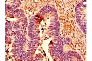 Immunohistochemistry of paraffin-embedded human ovarian cancer using ABIN7150430 at dilution of 1:100 (POLR2C Antikörper  (AA 2-275))
