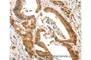 Immunohistochemistry of Human colon cancer using HTR3A Polyclonal Antibody at dilution of 1:50 (Serotonin Receptor 3A Antikörper)