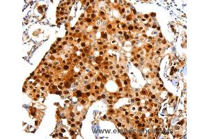 Immunohistochemistry of Human breast cancer using PCNA Polyclonal Antibody at dilution of 1:44 (PCNA Antikörper)
