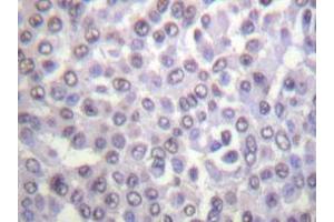 Immunohistochemistry analyzes of Histone H4 antibody in paraffin-embedded human breast carcinoma tissue. (Histone H4 Antikörper)