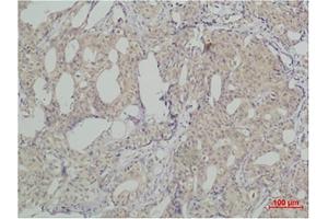 Immunohistochemical analysis of paraffin-embedded human breast caricnoma using SLUG Polyclonal Antibody. (SLUG Antikörper)