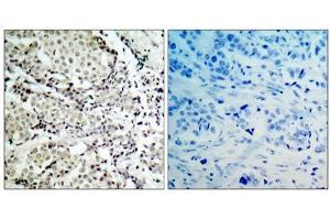 Immunohistochemical analysis of paraffin- embedded human breast carcinoma tissue, using MKK3 (Ab-189) antibody (E021116). (MAP2K3 Antikörper)