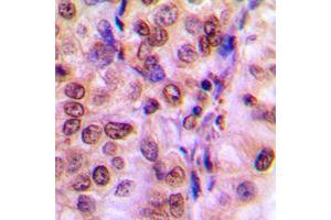 Immunohistochemical analysis of IRS1 staining in human breast cancer formalin fixed paraffin embedded tissue section. (IRS1 Antikörper  (Center))