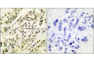 Immunohistochemistry analysis of paraffin-embedded human breast carcinoma tissue, using SKP1A/p19 Antibody. (SKP1 Antikörper  (AA 41-90))