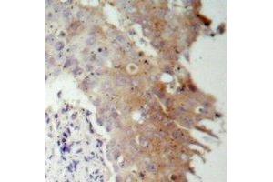 Immunohistochemical analysis of IRS1 staining in human prostate cancer formalin fixed paraffin embedded tissue section. (IRS1 Antikörper)