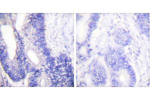Peptide - +Immunohistochemical analysis of paraffin-embedded human colon carcinoma tissue using Claudin 3 antibody. (Claudin 3 Antikörper)