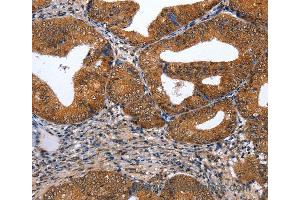 Immunohistochemistry of Human cervical cancer using GATA6 Polyclonal Antibody at dilution of 1:35 (GATA6 Antikörper)