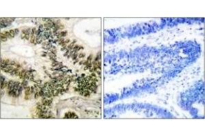 Immunohistochemistry analysis of paraffin-embedded human colon carcinoma tissue, using Cyclin E1 (Ab-395) Antibody. (Cyclin E1 Antikörper  (AA 361-410))